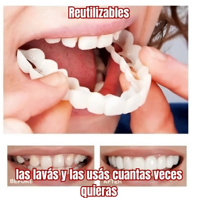 Carillas Dentales Snap On Smile